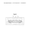 TOOTH ATTACHMENT PLACEMENT DEVICE diagram and image