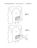 ADJUSTABLE ORTHODONTIC BRACKET AND METHOD diagram and image