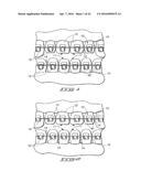 ORTHODONTIC BRACKET diagram and image