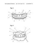 APPARATUS AND METHODS OF MAKING DENTURE DEVICES diagram and image