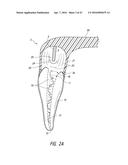 APPARATUS AND METHODS FOR CLEANING TEETH AND ROOT CANALS diagram and image