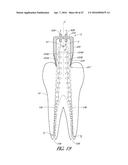 APPARATUS AND METHODS FOR CLEANING TEETH AND ROOT CANALS diagram and image