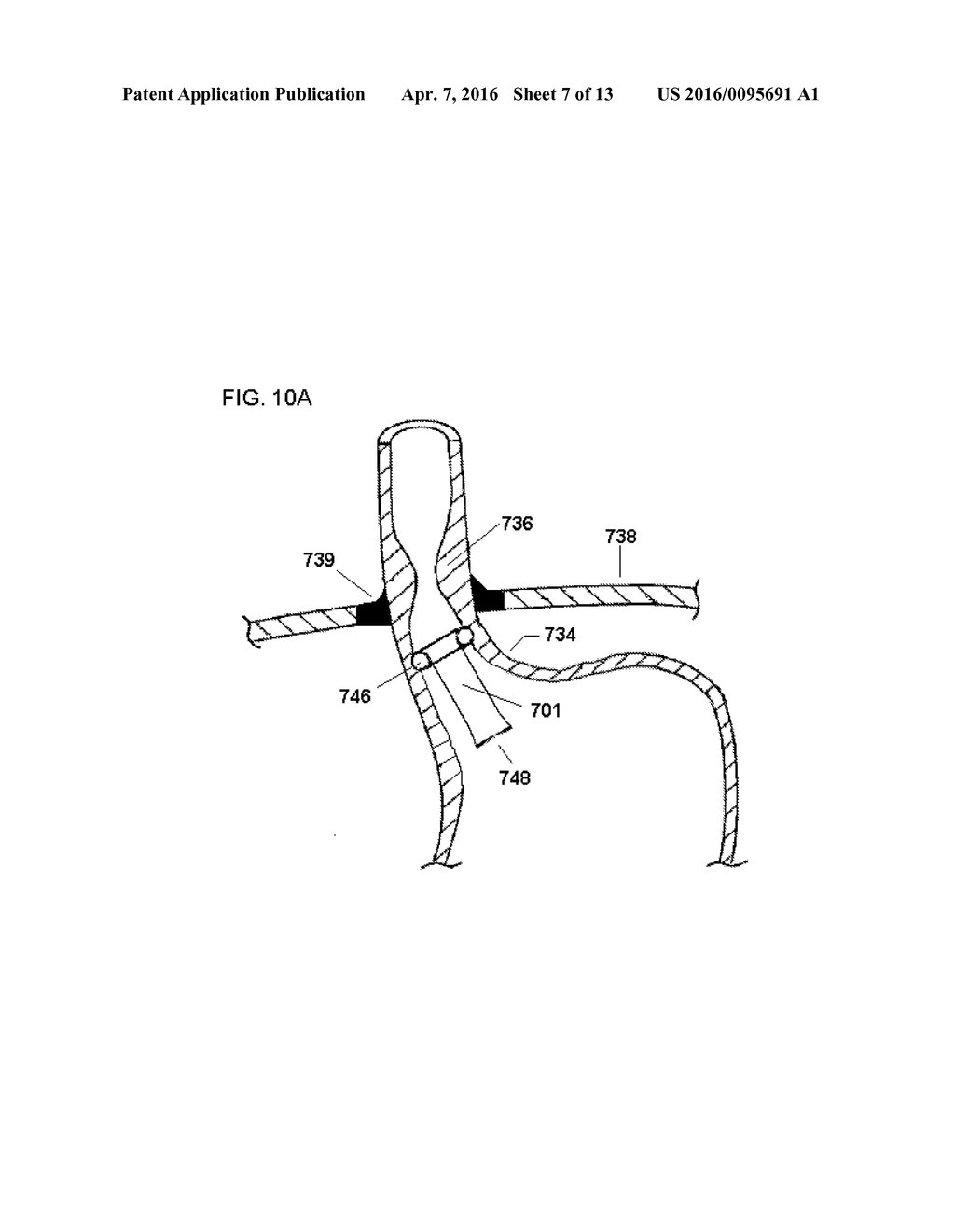 ANTI-REFLUX DEVICES AND METHODS FOR TREATING GASTRO-ESOPHAGEAL REFLUX     DISEASE (GERD) - diagram, schematic, and image 08