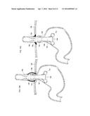 ANTI-REFLUX DEVICES AND METHODS FOR TREATING GASTRO-ESOPHAGEAL REFLUX     DISEASE (GERD) diagram and image