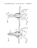 ANTI-REFLUX DEVICES AND METHODS FOR TREATING GASTRO-ESOPHAGEAL REFLUX     DISEASE (GERD) diagram and image