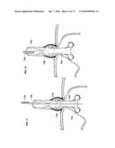 ANTI-REFLUX DEVICES AND METHODS FOR TREATING GASTRO-ESOPHAGEAL REFLUX     DISEASE (GERD) diagram and image