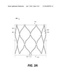 Bi-Leaflet Mitral Valve Design diagram and image