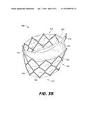 Bi-Leaflet Mitral Valve Design diagram and image