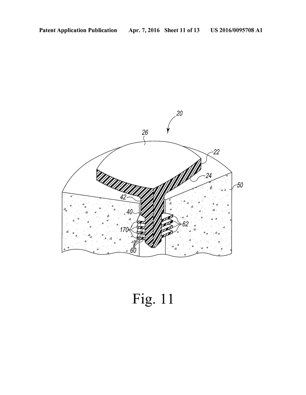 MODIFIED GLENOID COMPONENTS AND METHODS OF INSTALLING SAME - diagram, schematic, and image 12