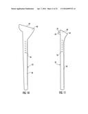 SYSTEM FOR TREATING PROXIMAL HUMERAL FRACTURES AND METHOD OF USING THE     SAME diagram and image