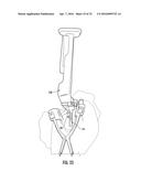 SYSTEM FOR TREATING PROXIMAL HUMERAL FRACTURES AND METHOD OF USING THE     SAME diagram and image