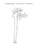 SYSTEM FOR TREATING PROXIMAL HUMERAL FRACTURES AND METHOD OF USING THE     SAME diagram and image