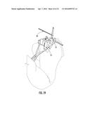 SYSTEM FOR TREATING PROXIMAL HUMERAL FRACTURES AND METHOD OF USING THE     SAME diagram and image