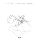 SYSTEM FOR TREATING PROXIMAL HUMERAL FRACTURES AND METHOD OF USING THE     SAME diagram and image