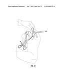 SYSTEM FOR TREATING PROXIMAL HUMERAL FRACTURES AND METHOD OF USING THE     SAME diagram and image