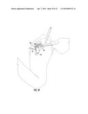 SYSTEM FOR TREATING PROXIMAL HUMERAL FRACTURES AND METHOD OF USING THE     SAME diagram and image