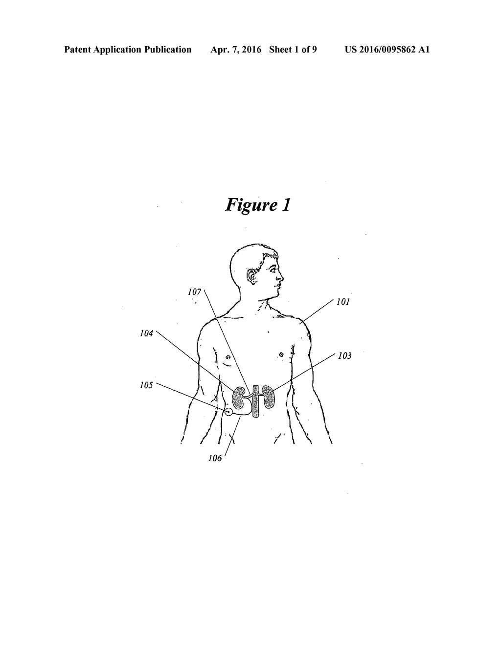 Methods and Devices for Renal Nerve Blocking - diagram, schematic, and image 02