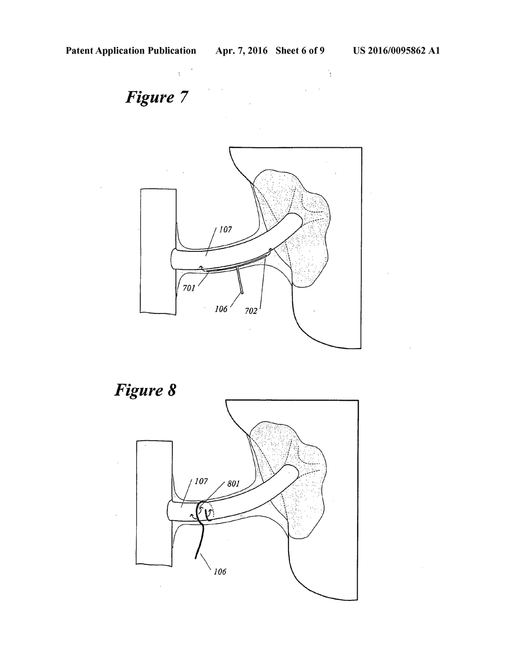 Methods and Devices for Renal Nerve Blocking - diagram, schematic, and image 07