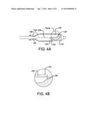 REMOVABLE COVERS FOR DRUG ELUTING MEDICAL DEVICES diagram and image