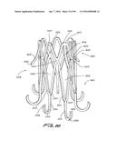 IMPLANTABLE FLOW CONNECTOR diagram and image