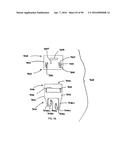 IMPLANTABLE FLOW CONNECTOR diagram and image