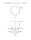 IMPLANTABLE FLOW CONNECTOR diagram and image