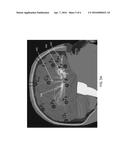 Enhanced Spatial Summation for Deep-Brain Transcranial Magnetic     Stimulation diagram and image