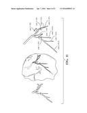 METHOD FOR ASSESSING STENOSIS SEVERITY IN A LESION TREE THROUGH STENOSIS     MAPPING diagram and image