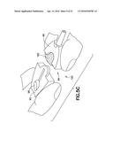 Blood Sample Management Using Open Cell Foam diagram and image