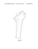 PATIENT-SPECIFIC FEMORAL VERSION GUIDE diagram and image