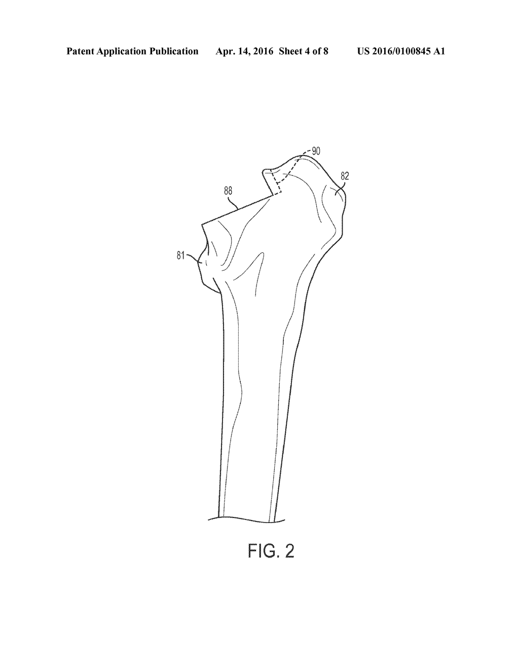 PATIENT-SPECIFIC FEMORAL VERSION GUIDE - diagram, schematic, and image 05