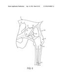 PATIENT-SPECIFIC FEMORAL VERSION GUIDE diagram and image