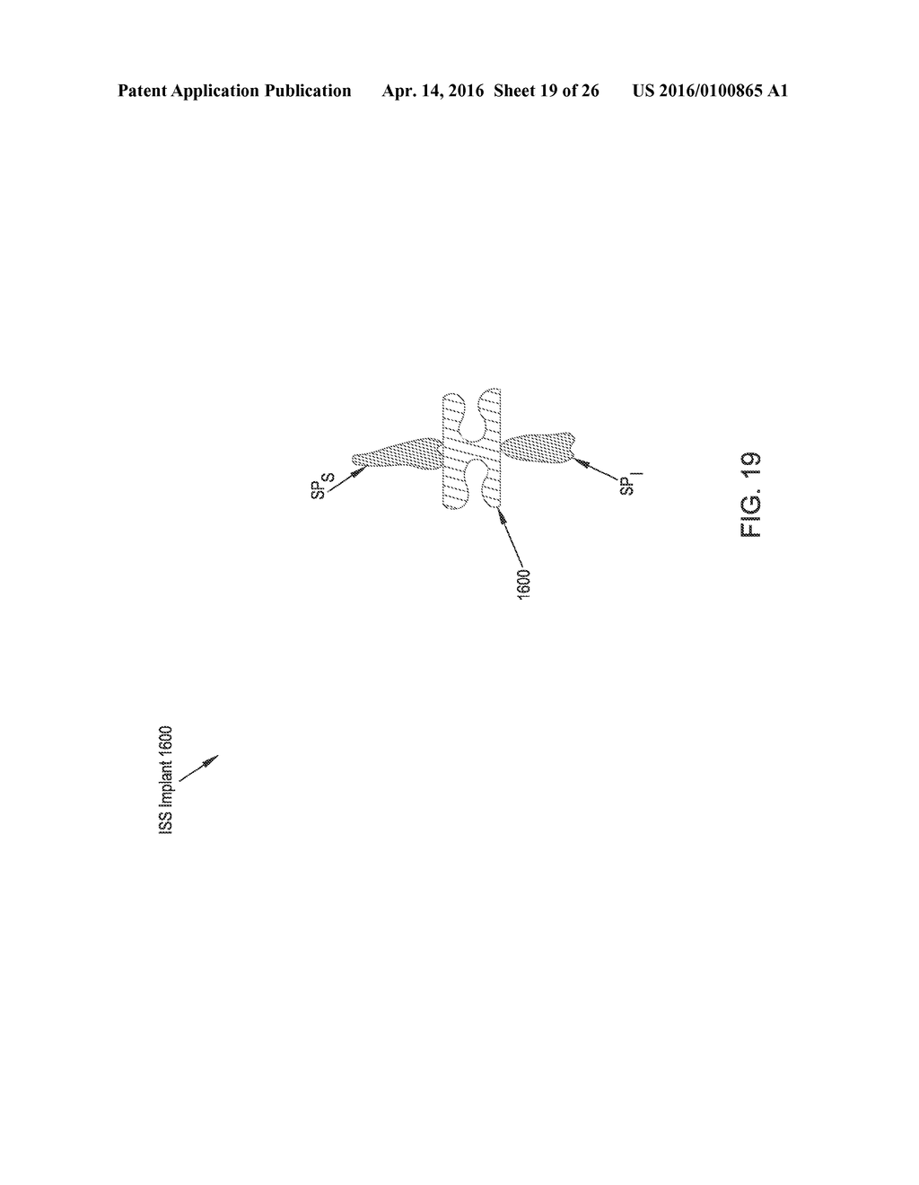 MINIMALLY INVASIVE INTERSPINOUS PROCESS SPACER IMPLANTS AND METHODS - diagram, schematic, and image 20