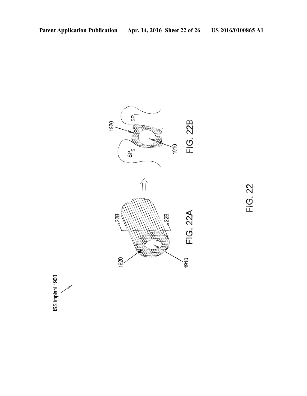 MINIMALLY INVASIVE INTERSPINOUS PROCESS SPACER IMPLANTS AND METHODS - diagram, schematic, and image 23