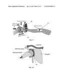 SYSTEM AND METHOD FOR INTRAOPERATIVE JOINT CONTACT MECHANICS MEASUREMENT diagram and image