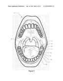 DENTAL ORAL SHIELD DEVICE AND SYSTEM diagram and image