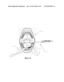 DENTAL ORAL SHIELD DEVICE AND SYSTEM diagram and image