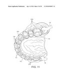 MOLDED DENTURE AND METHOD AND APPARATUS OF MAKING SAME diagram and image