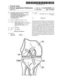 METHODS AND SYSTEMS FOR FORMING UNICOMPARTMENTAL AND UNICONDYLAR KNEE     RESURFACING IN CONJUNCTION WITH CRUCIATE LIGAMENT REPLACEMENT     CONCOMITANTLY diagram and image