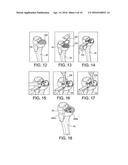 METHODS AND SYSTEMS FOR FORMING UNICOMPARTMENTAL AND UNICONDYLAR KNEE     RESURFACING IN CONJUNCTION WITH CRUCIATE LIGAMENT REPLACEMENT     CONCOMITANTLY diagram and image