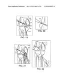 METHODS AND SYSTEMS FOR FORMING UNICOMPARTMENTAL AND UNICONDYLAR KNEE     RESURFACING IN CONJUNCTION WITH CRUCIATE LIGAMENT REPLACEMENT     CONCOMITANTLY diagram and image