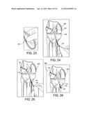 METHODS AND SYSTEMS FOR FORMING UNICOMPARTMENTAL AND UNICONDYLAR KNEE     RESURFACING IN CONJUNCTION WITH CRUCIATE LIGAMENT REPLACEMENT     CONCOMITANTLY diagram and image