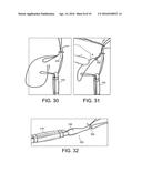 METHODS AND SYSTEMS FOR FORMING UNICOMPARTMENTAL AND UNICONDYLAR KNEE     RESURFACING IN CONJUNCTION WITH CRUCIATE LIGAMENT REPLACEMENT     CONCOMITANTLY diagram and image