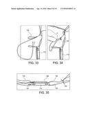 METHODS AND SYSTEMS FOR FORMING UNICOMPARTMENTAL AND UNICONDYLAR KNEE     RESURFACING IN CONJUNCTION WITH CRUCIATE LIGAMENT REPLACEMENT     CONCOMITANTLY diagram and image