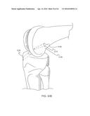 GRAFT FIXATION diagram and image