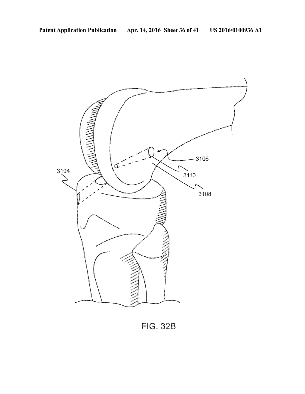 GRAFT FIXATION - diagram, schematic, and image 37