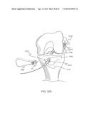 GRAFT FIXATION diagram and image