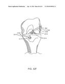 GRAFT FIXATION diagram and image