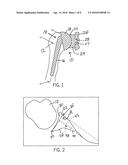 Method for Optimization of Joint Arthroplasty Component Design diagram and image