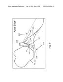 Method for Optimization of Joint Arthroplasty Component Design diagram and image